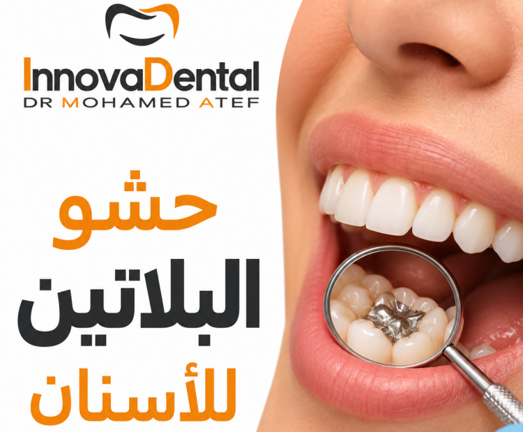 حشو البلاتين للاسنان: الحل الأقوى للضروس | عيادات انوفا